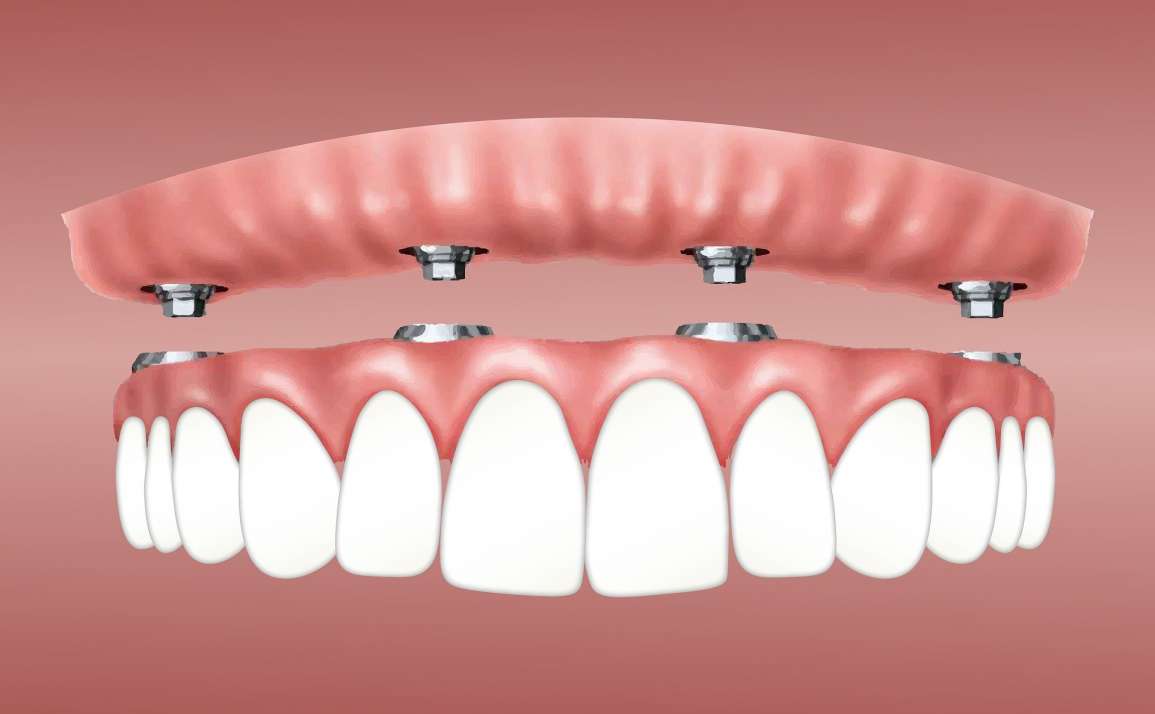 ¿Qué es un implante dental y cuándo es la opción que necesito?