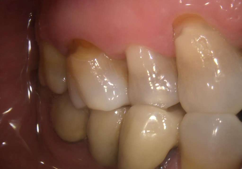 Qué es y cómo combatir la abfracción dental o el desgaste de los dientes