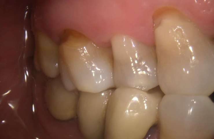 Qué es y cómo combatir la abfracción dental o el desgaste de los dientes