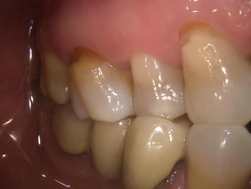 Abfracción dental
