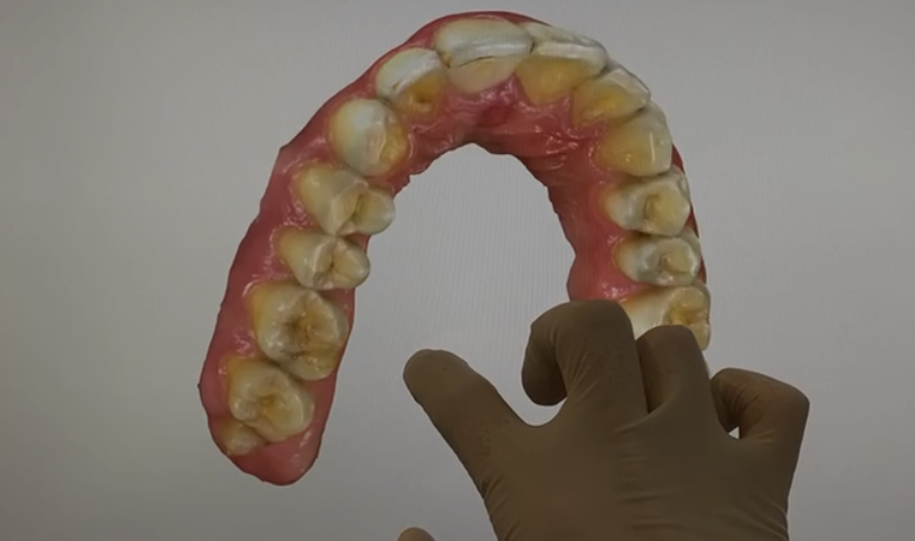 Escáner intraoral y Naturdent