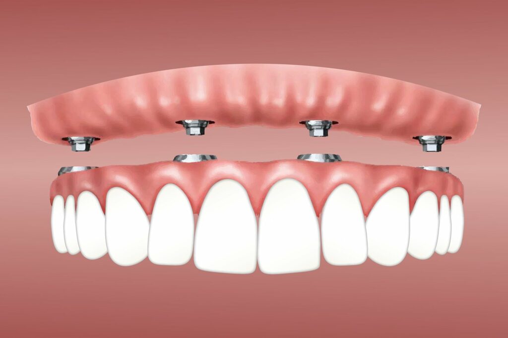 Implante dental