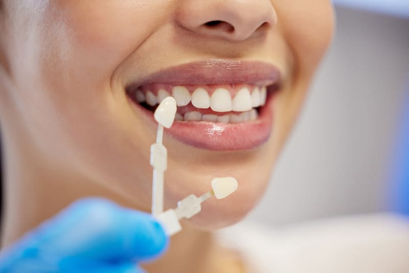 Carilla dental